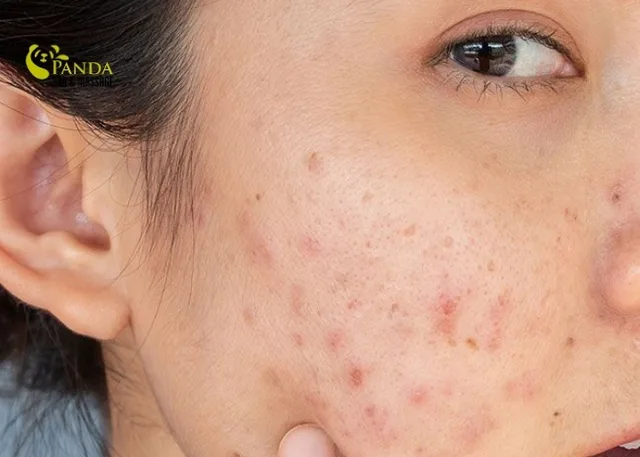 여드름 세안제가 피부를 깊게 세정하고 회복시켜줍니다